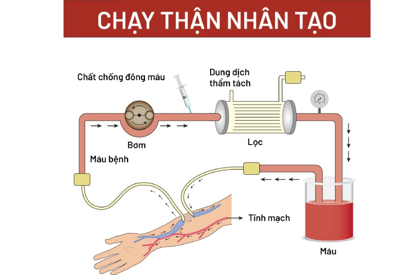 Chạy thận nhân tạo giúp người bệnh suy thận độ 4 kéo dài sự sống